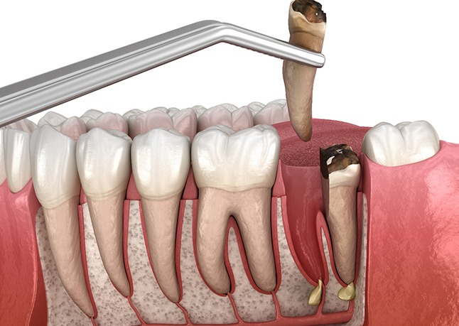 3D render extracting a broken tooth