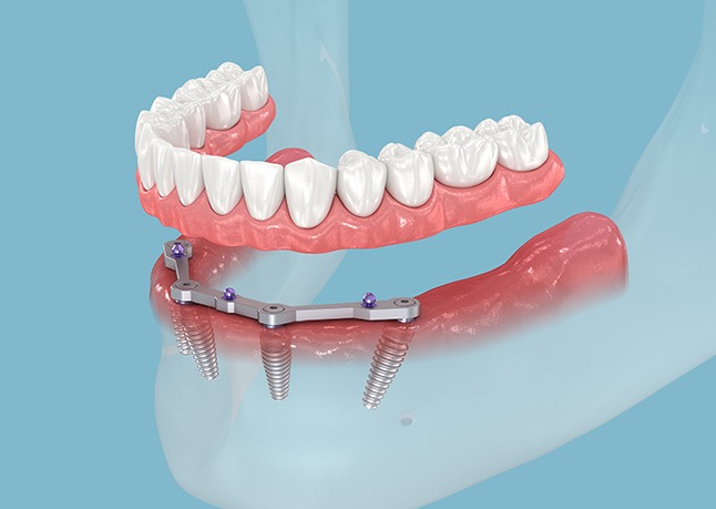 Side-view illustration of All-on-4 dental implants