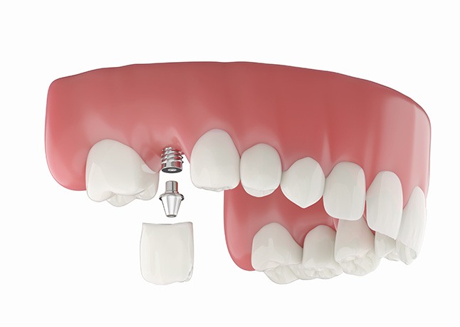 Illustration of single dental implant between natural teeth