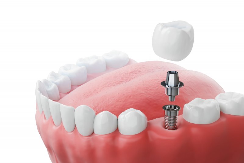 a 3D illustration of a titanium dental implant